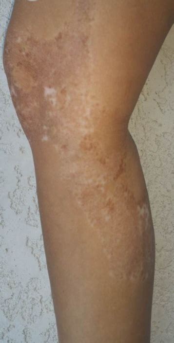 Vitiligo Photo Gallery – Global Vitiligo Foundation